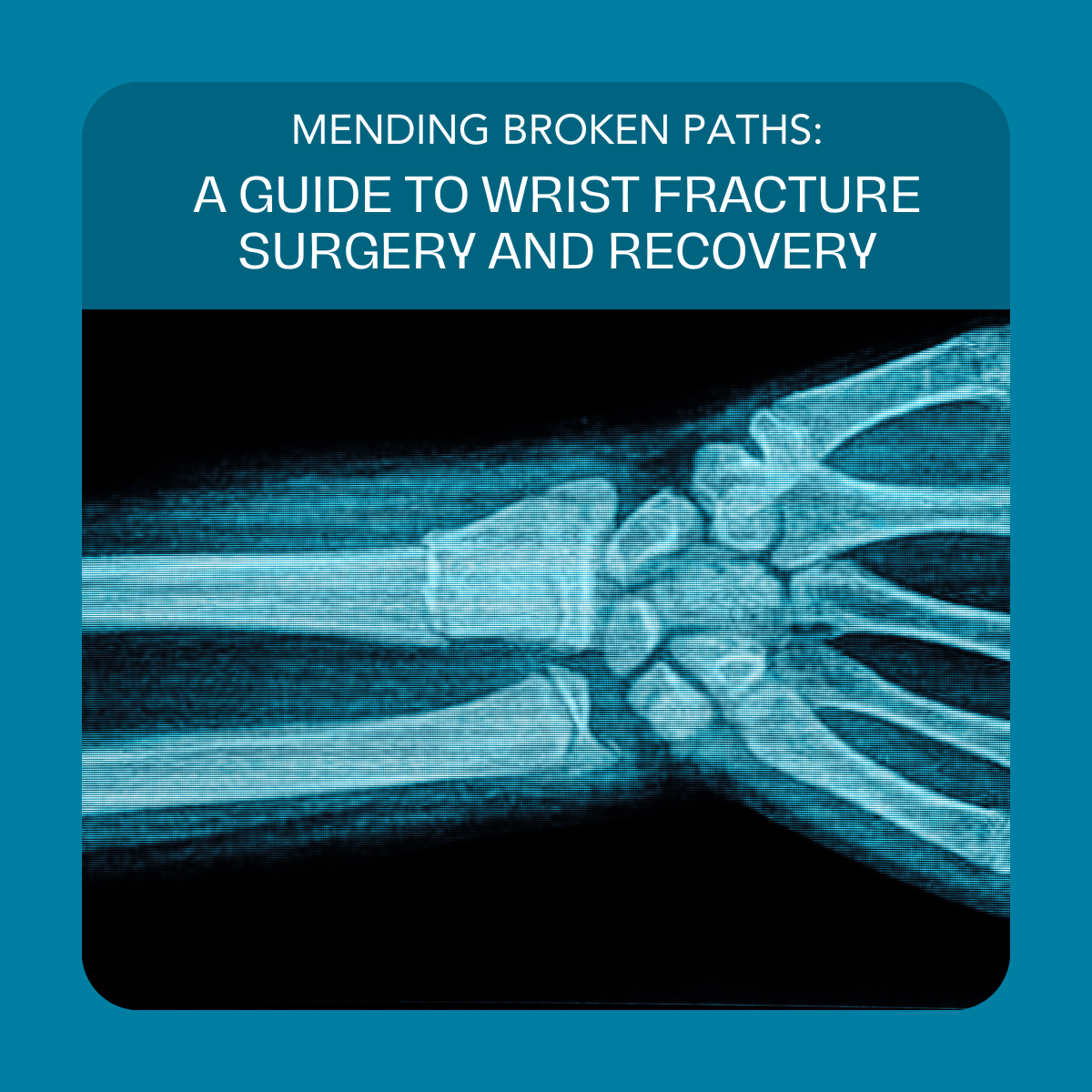 Guide To Wrist Fracture Surgery And Recovery Monadnock Orthopaedic