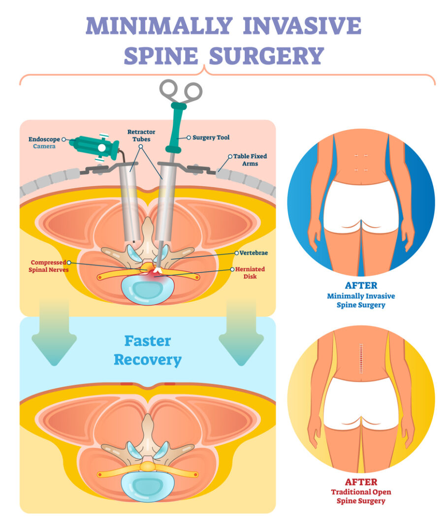 An infographic comparing minimally invasive spine surgery with traditional open spine surgery. The top half shows surgical instruments and a herniated disk. The bottom half shows a comparison of recovery times, with "Faster Recovery" highlighted. To the right, two diagrams illustrate the scars from minimally invasive and traditional open spine surgeries