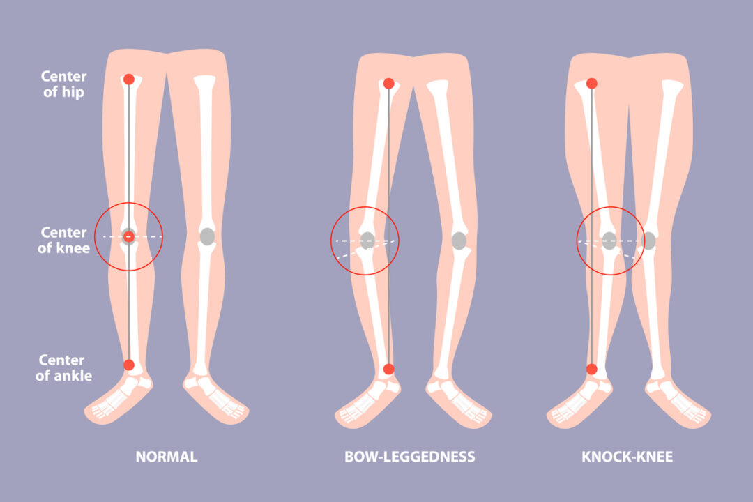 An illustration comparing normal leg alignment, bow-leggedness, and knock-knee. Each diagram shows the positions of the center of the hip, knee, and ankle, with circles highlighting the differences in alignment among the three conditions