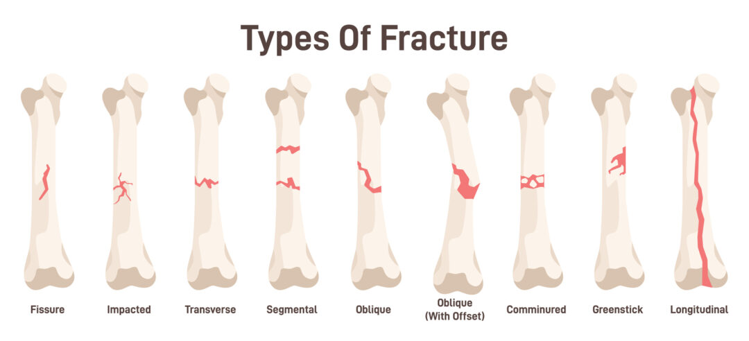 An illustration showing different types of bone fractures. Each bone displays a specific type of fracture, including fissure, impacted, transverse, segmental, oblique, oblique (with offset), comminuted, greenstick, and longitudinal