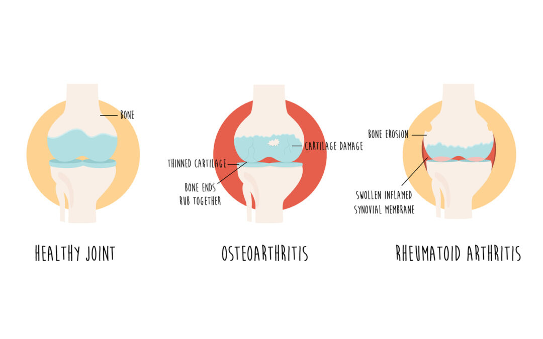 Illustration comparing three joint conditions: a healthy joint on the left, showing normal bone and cartilage; osteoarthritis in the middle, with thinned cartilage, bone ends rubbing together, and cartilage damage; and rheumatoid arthritis on the right, displaying bone erosion, swollen synovial membrane, and joint inflammation