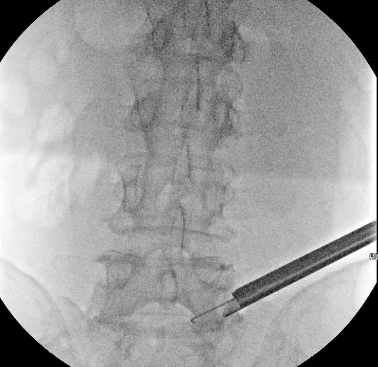 X-ray showing the positioning of a surgical instrument during endoscopic spine surgery in the lumbar region.